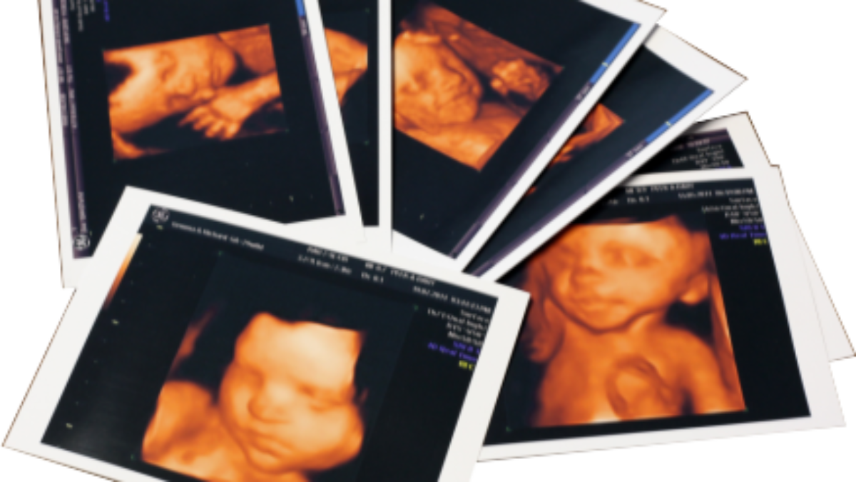 Pregnancy pictures ultrasound of Complete List
