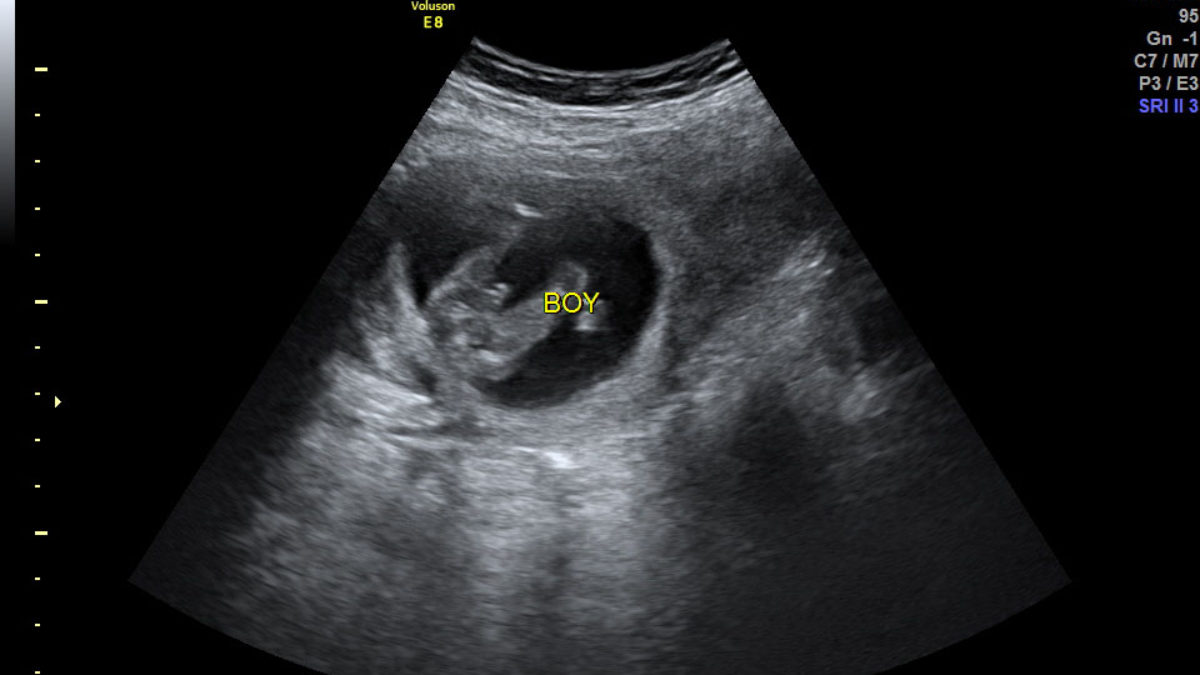 Early Boy Gender Scan Peek A Baby