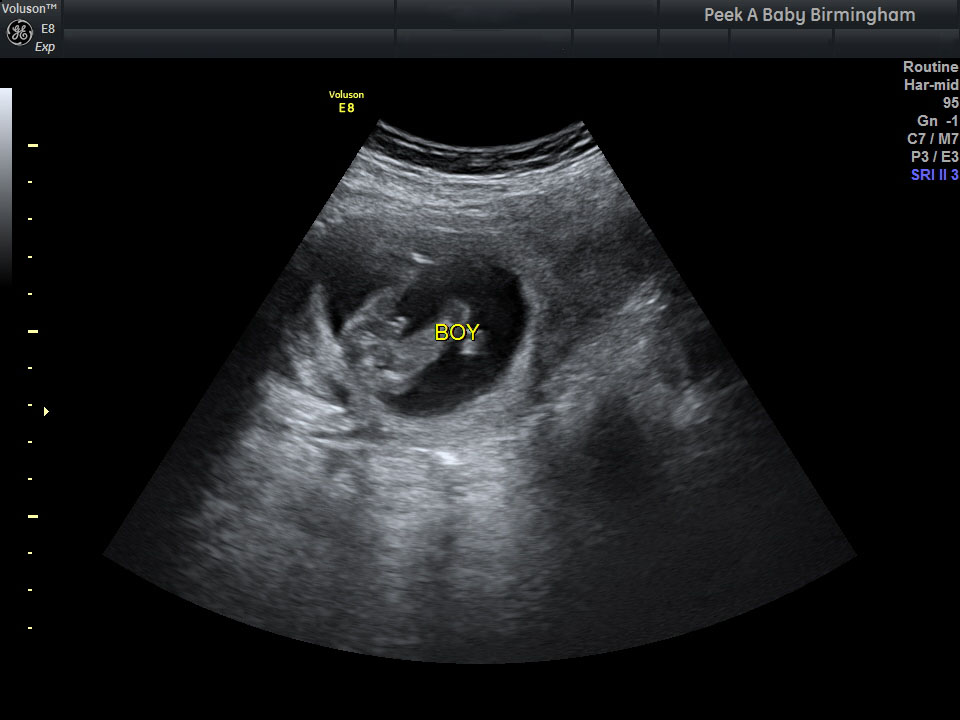 Early boy gender scan