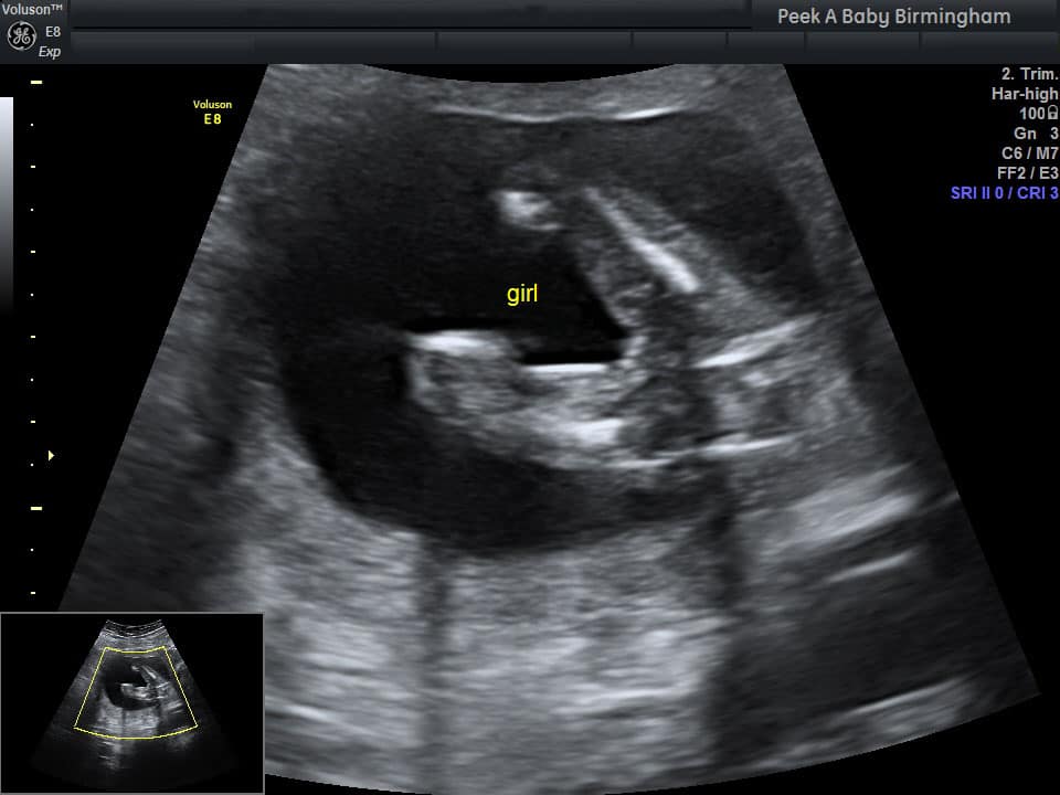 Early girl gender scan Photo